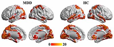 Changed Hub and Corresponding Functional Connectivity of Subgenual Anterior Cingulate Cortex in Major Depressive Disorder